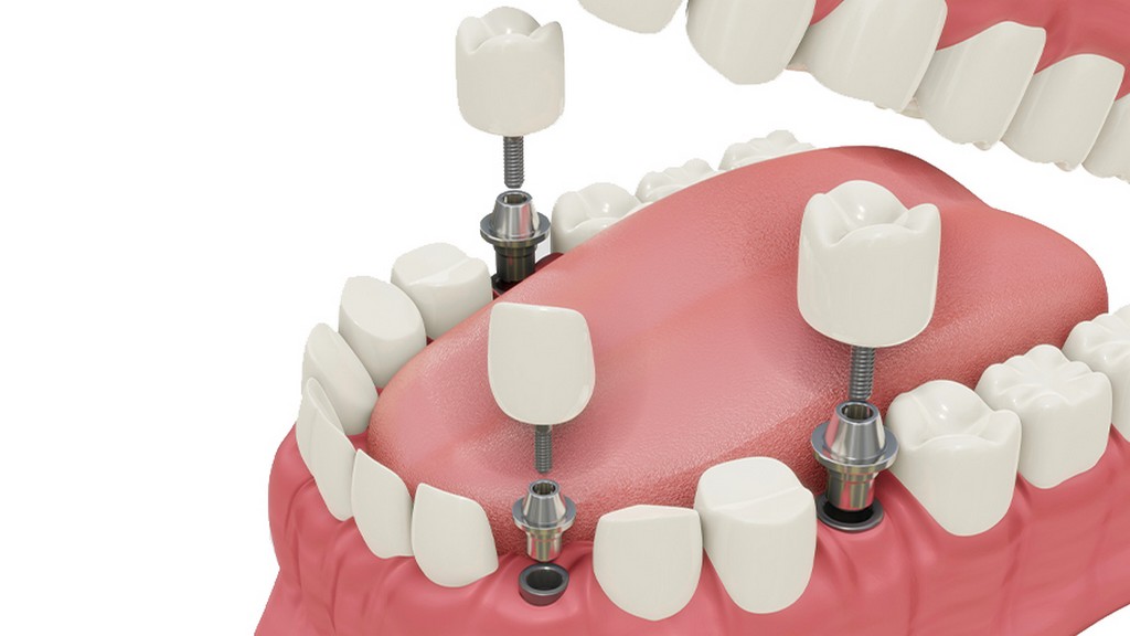 Dental İmplantlar