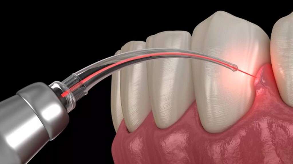 Dental Lazerler