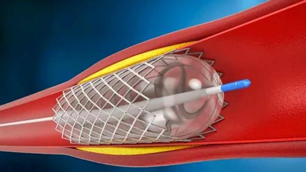 Balon Anjiyoplasti Sistemleri