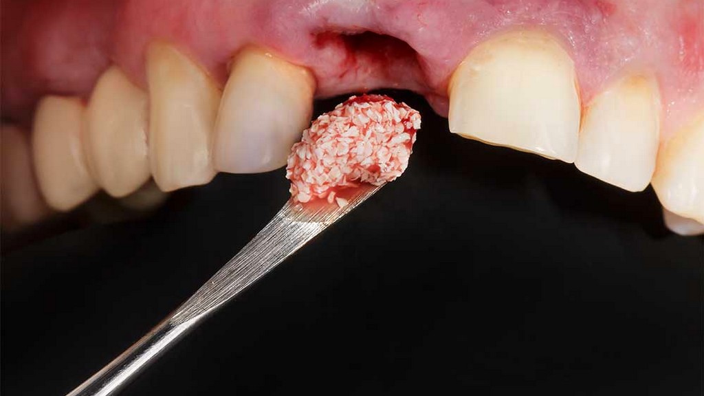 Bone Graft Malzemeleri