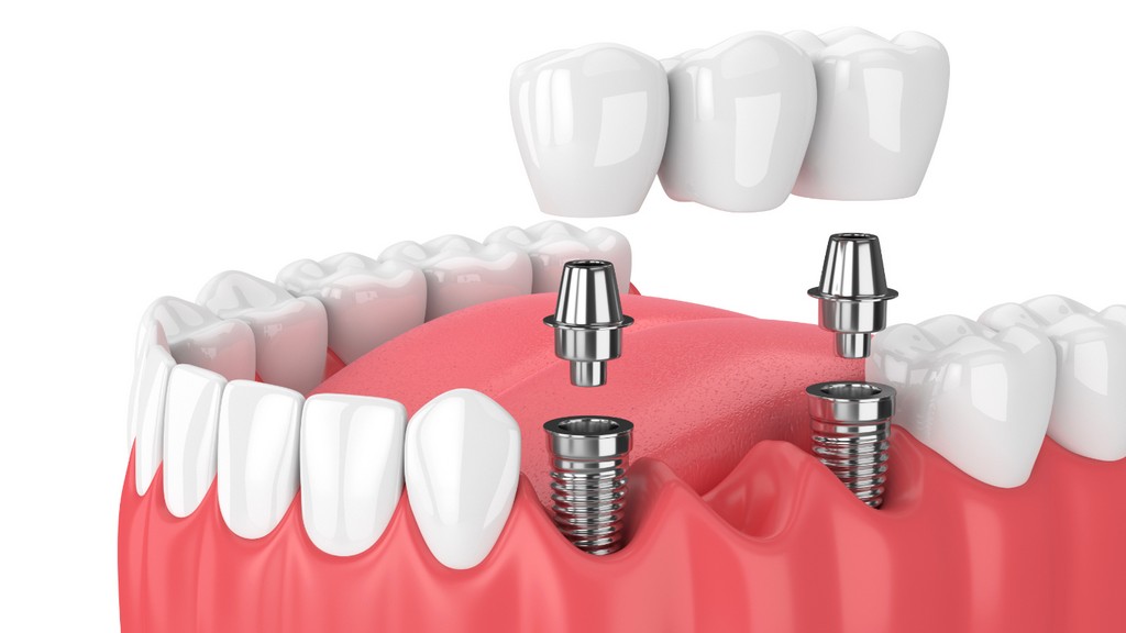 Dental İmplant Sistemleri