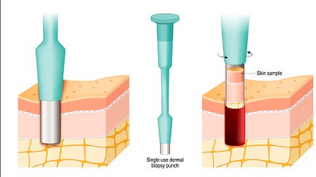 Dermatolojik Punchlar