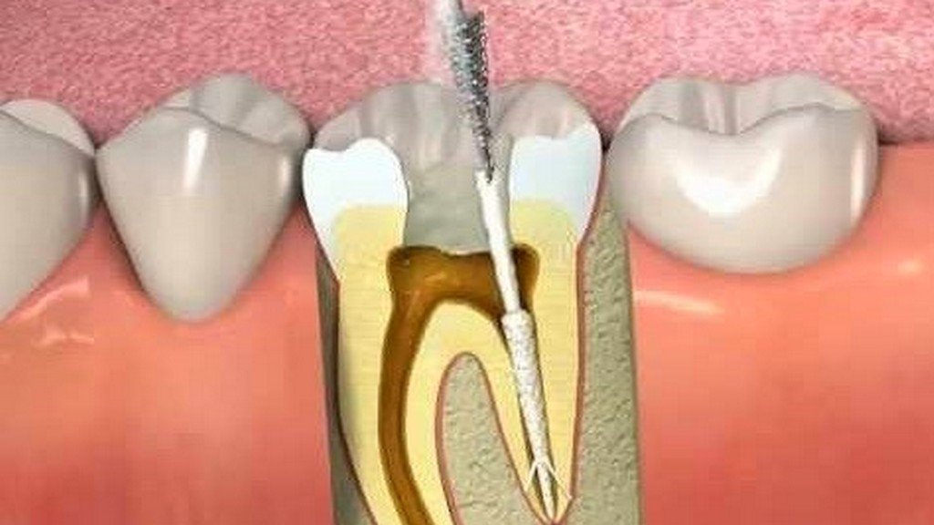 Endodontik Dolgu Malzemeleri