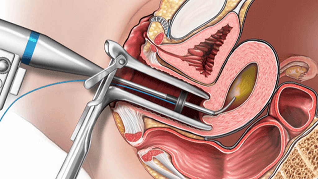 Endometrial Biyopsi Aletleri