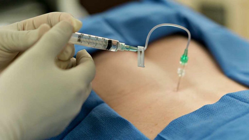 Epidural Nöral Blok Setleri