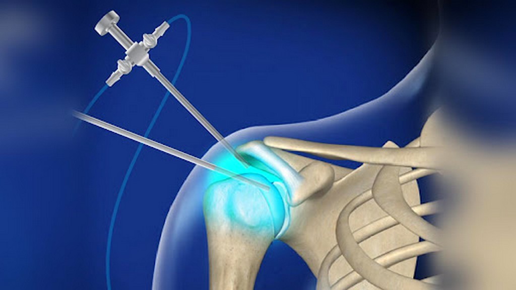 Esnek Arthroskoplar