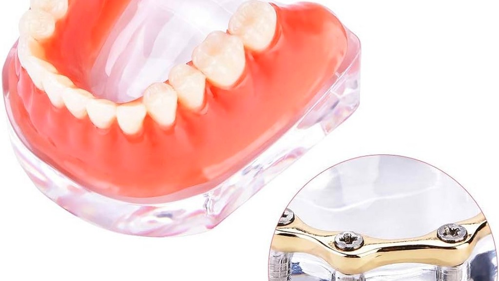İmplant Overdenture Ekipmanları