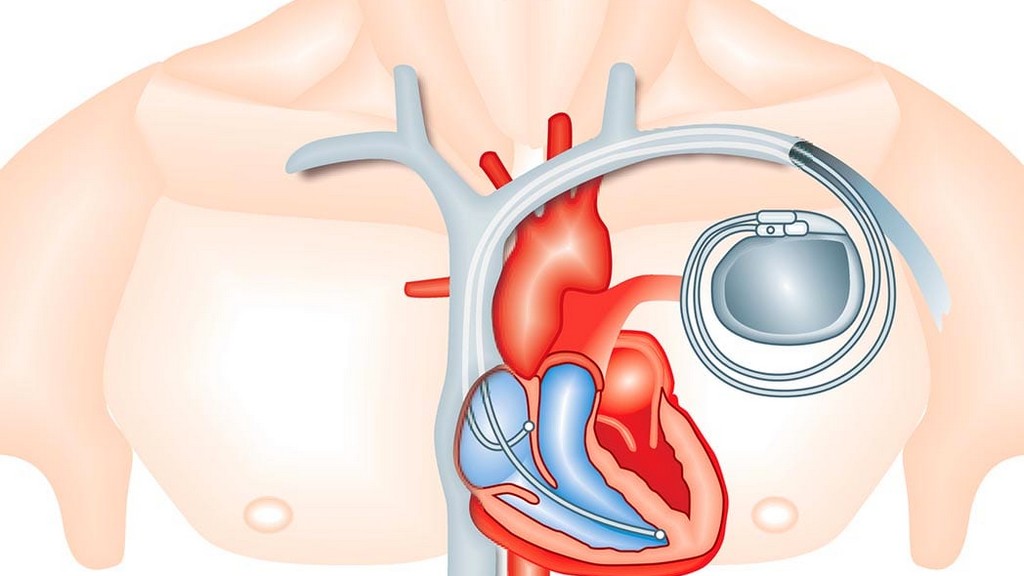 İmplante Edilebilir Kardiyoverter Defibrilatörler (ICD)