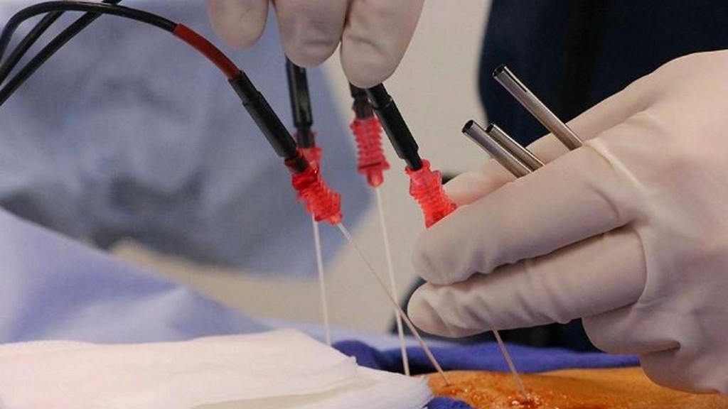 Lazer Ablasyon Cihazları