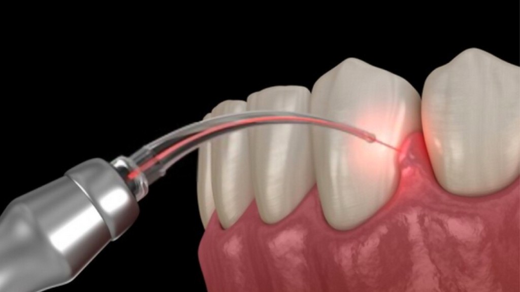 Periodontal Lazerler