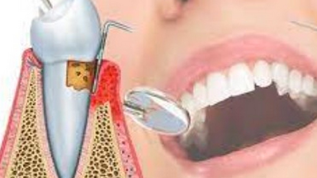 Periodontal Tedavi Üniteleri
