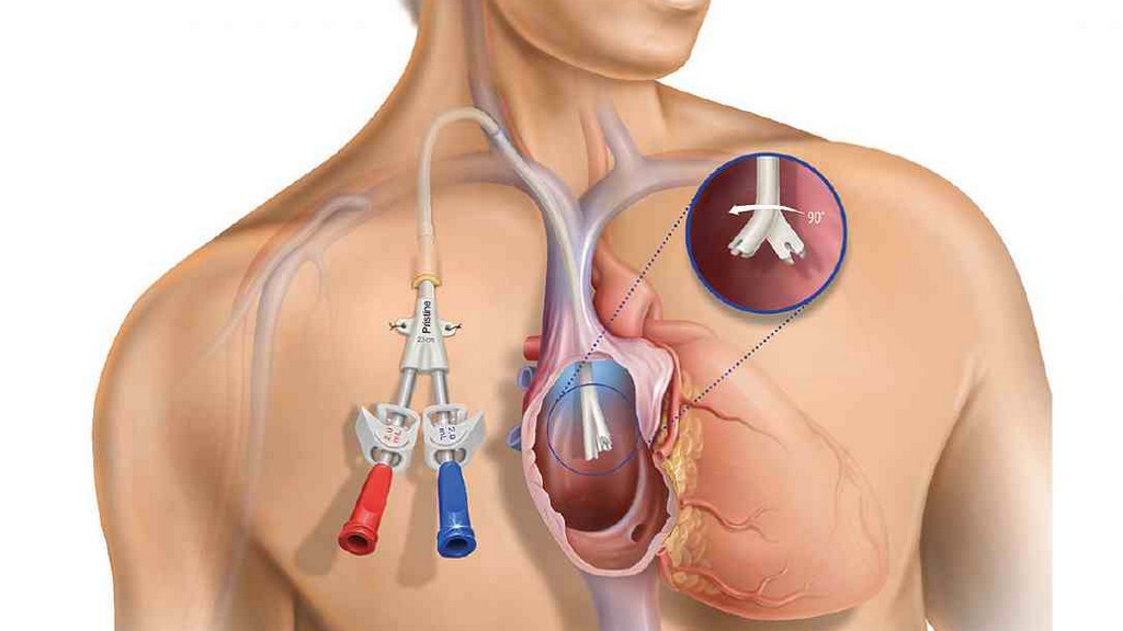Rijit Transfer Kateterleri