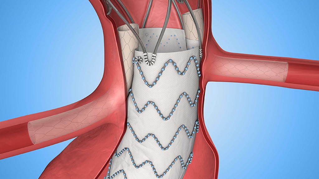 Stent-Graft Sistemleri