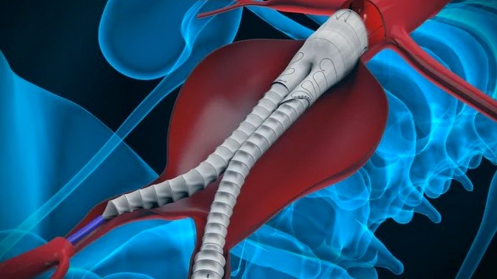 Stent ve Stent Graft Sistemleri