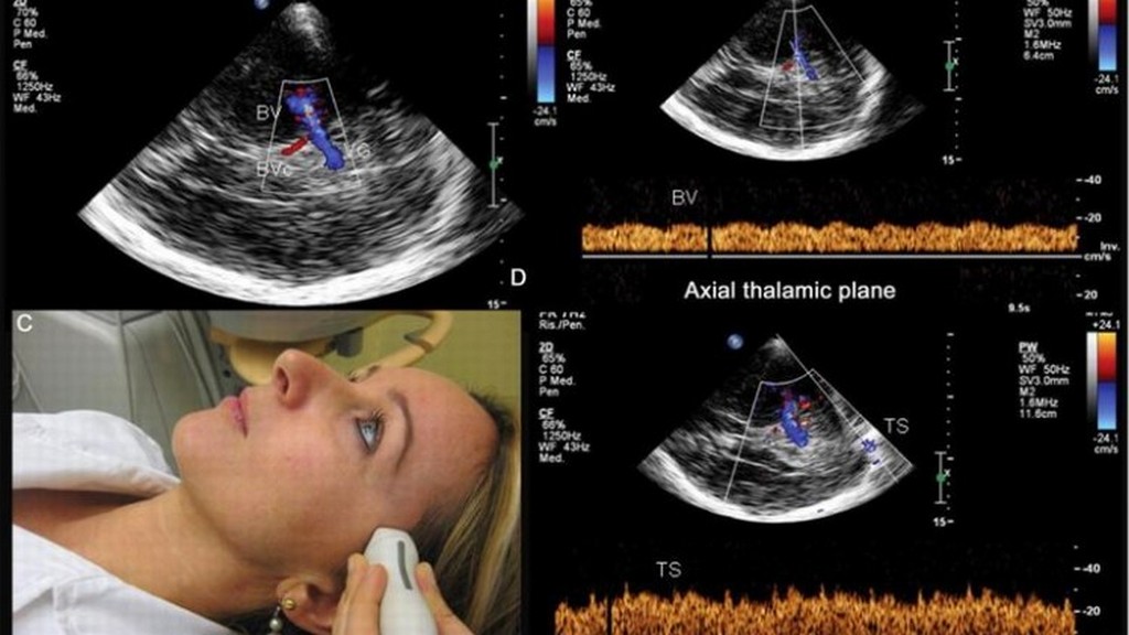 Transkraniyal Doppler Sistemleri