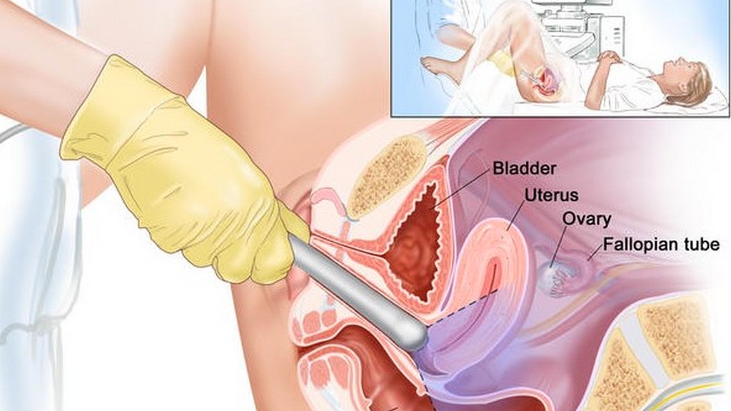 Transvajinal Ultrason Sistemleri