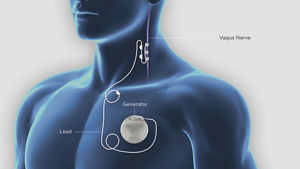Vagus Sinir Stimülasyonu (VNS) Cihazları